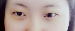 咸阳公立医院青薇做的双眼皮,王磊做的开眼角