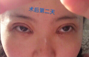 咸阳公立医院青薇做的双眼皮,王磊做的开眼角