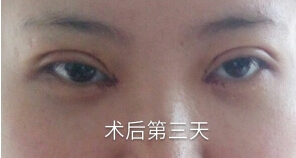 咸阳公立医院青薇做的双眼皮,王磊做的开眼角