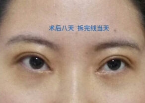 咸阳公立医院青薇做的双眼皮,王磊做的开眼角