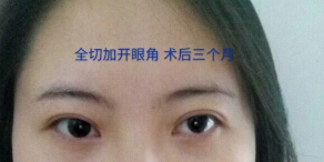 咸阳公立医院青薇做的双眼皮,王磊做的开眼角