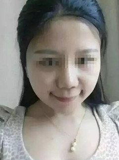 分享几个鼻部问题改良的案例