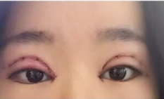 全切双眼皮手术+开内眼角手术+眶隔释放去眼袋