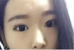 全切双眼皮手术+开内眼角手术+眶隔释放去眼袋