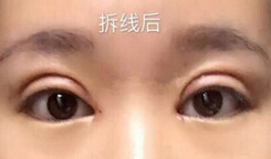 全切双眼皮手术+开内眼角手术+眶隔释放去眼袋