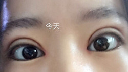 全切双眼皮手术+开内眼角手术+眶隔释放去眼袋