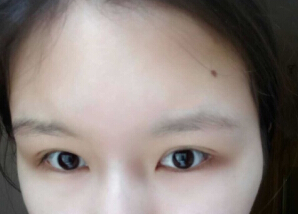 武汉美莱卓田医生做的双眼皮手术果