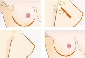 哪个年龄段容易长副乳?