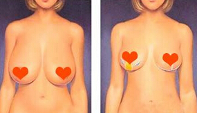 做乳房下垂矫正什么方法好?