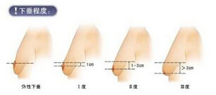 做乳房下垂矫正什么方法好?