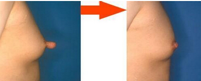 女性的乳晕太大能够改良吗？