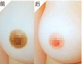 女性的乳晕太大能够改良吗？
