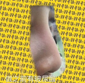 无锡丽都整形医院陈光平院长鼻部手术手术案例