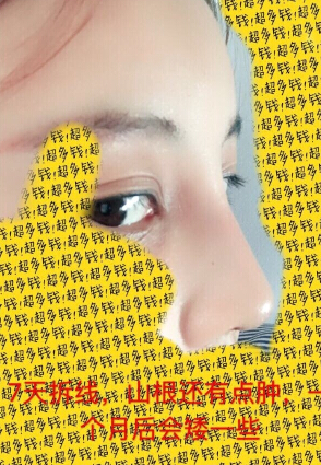 无锡丽都整形医院陈光平院长鼻部手术手术案例