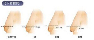乳房下垂矫正后,还会再垂吗?