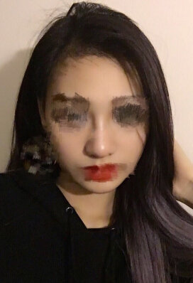 南京康美房志强主任做的鼻部手术手术案例