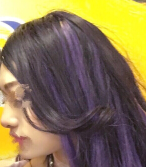 南京康美房志强主任做的鼻部手术手术案例