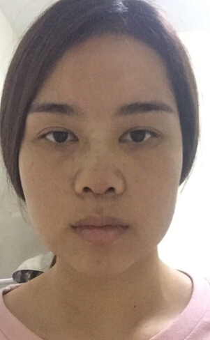 湘雅附二王先成医生手术案例