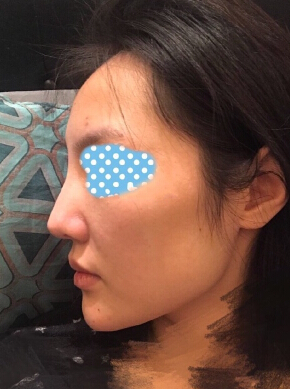 玻尿酸面部填充术后果反馈