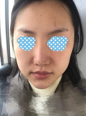 玻尿酸面部填充术后果反馈