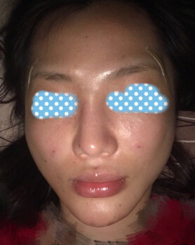 玻尿酸面部填充术后果反馈