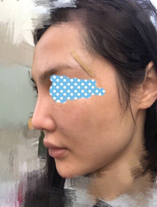 玻尿酸面部填充术后果反馈