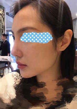玻尿酸面部填充术后果反馈
