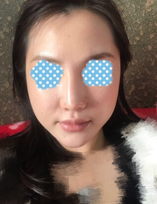 玻尿酸面部填充术后果反馈