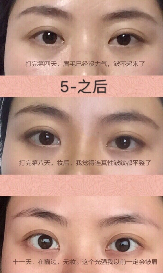 分享案例，注射瘦脸除眉间纹