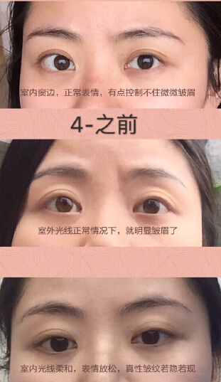 分享案例，注射瘦脸除眉间纹