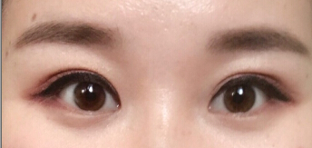 北京同仁韩新鸣医生做的双眼皮手术果
