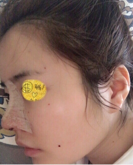 华颜黄富伟做的脂肪填充,贾德渊做的鼻部手术