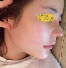 华颜黄富伟做的脂肪填充,贾德渊做的鼻部手术