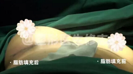 隆胸后，真胸和假胸可以鉴别吗？