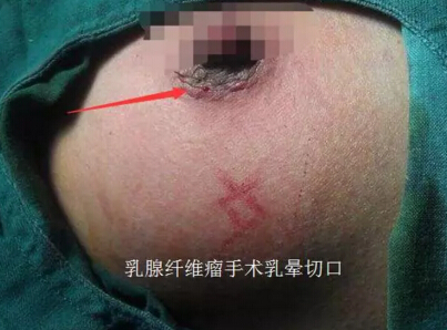 隆胸后，真胸和假胸可以鉴别吗？