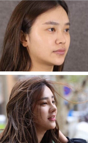 大连明医汇刘威医生做的肋软骨鼻部手术