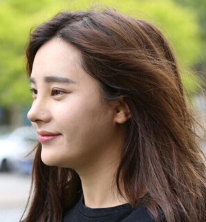 大连明医汇刘威医生做的肋软骨鼻部手术