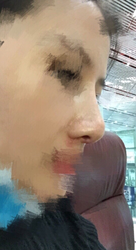 北京八大处石蕾医生做的鼻部手术手术案例