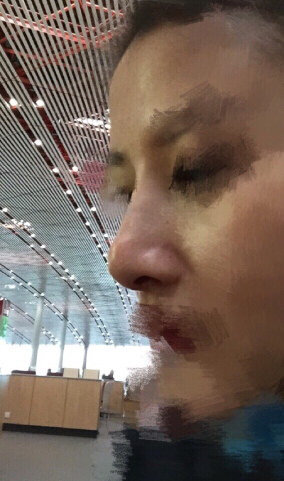 北京八大处石蕾医生做的鼻部手术手术案例