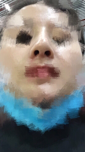 北京八大处石蕾医生做的鼻部手术手术案例