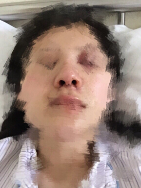 北京八大处石蕾医生做的鼻部手术手术案例