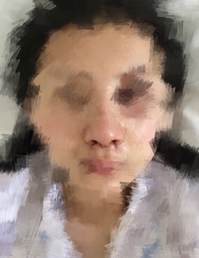 北京八大处石蕾医生做的鼻部手术手术案例