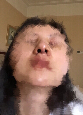 北京八大处石蕾医生做的鼻部手术手术案例