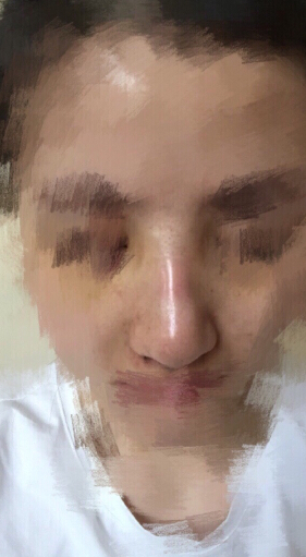 北京八大处石蕾医生做的鼻部手术手术案例