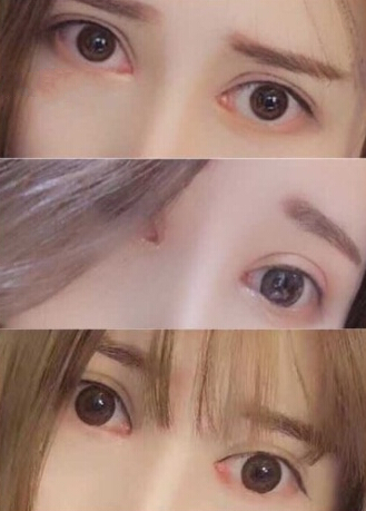 奕后整形美容医院鼻部手术手术案例