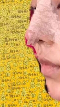 奕后整形美容医院鼻部手术手术案例