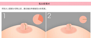 乳头缩小手术多少钱?
