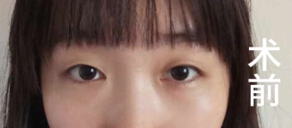 成都良好美妍徐彬徐院长手术案例