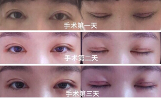 成都良好美妍徐彬徐院长手术案例
