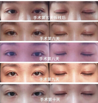 成都良好美妍徐彬徐院长手术案例